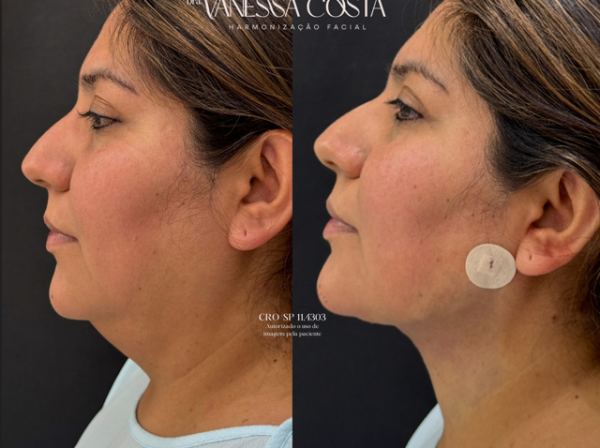 ANTES  | DEPOIS