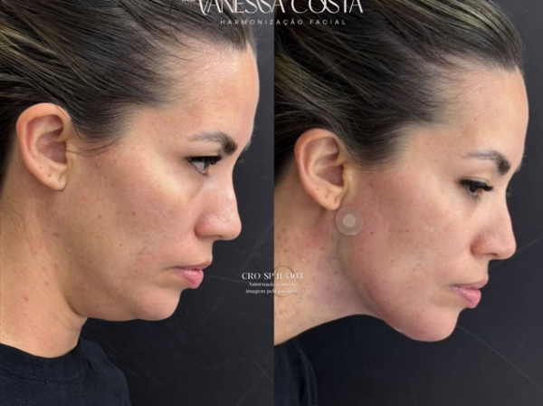 ANTES  | DEPOIS