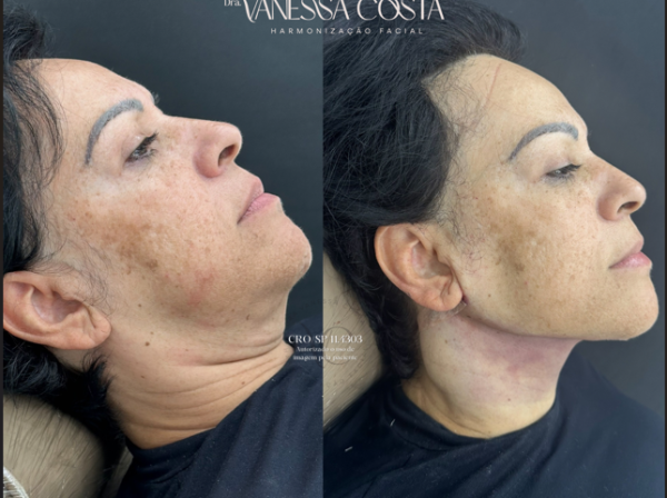 ANTES  | DEPOIS