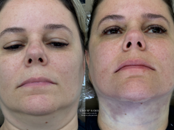 ANTES  | DEPOIS