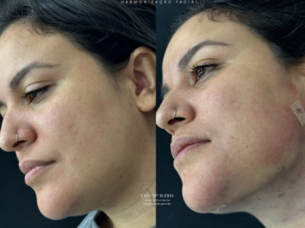 ANTES  | DEPOIS
