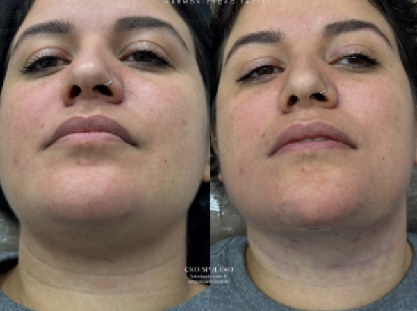 ANTES  | DEPOIS