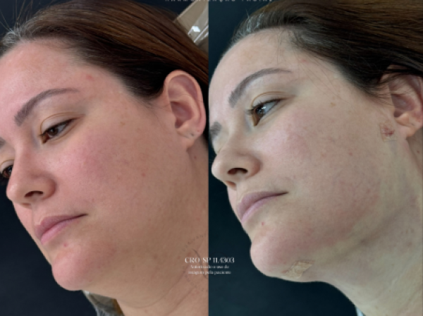 ANTES  | DEPOIS