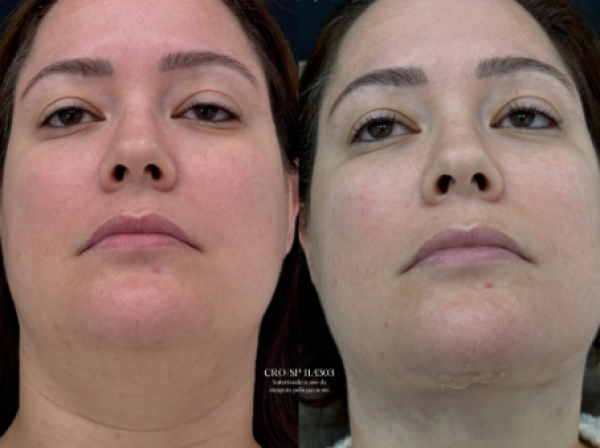 ANTES  | DEPOIS