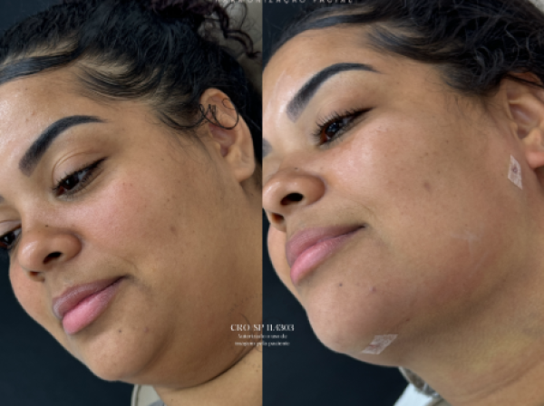ANTES  | DEPOIS