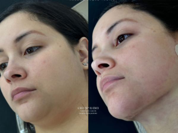 ANTES  | DEPOIS