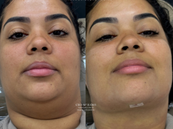 ANTES  | DEPOIS