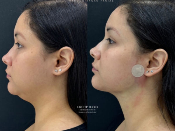 ANTES  | DEPOIS