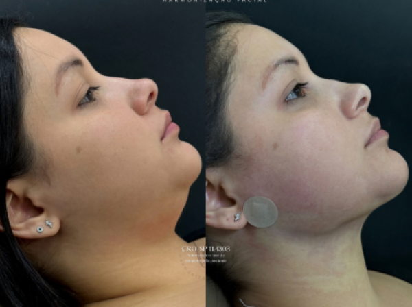 ANTES  | DEPOIS