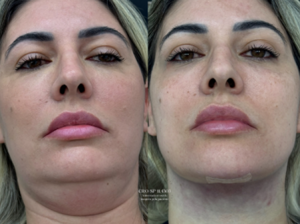 ANTES  | DEPOIS