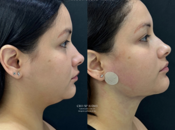 ANTES  | DEPOIS