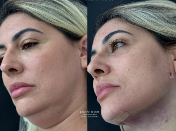 ANTES  | DEPOIS