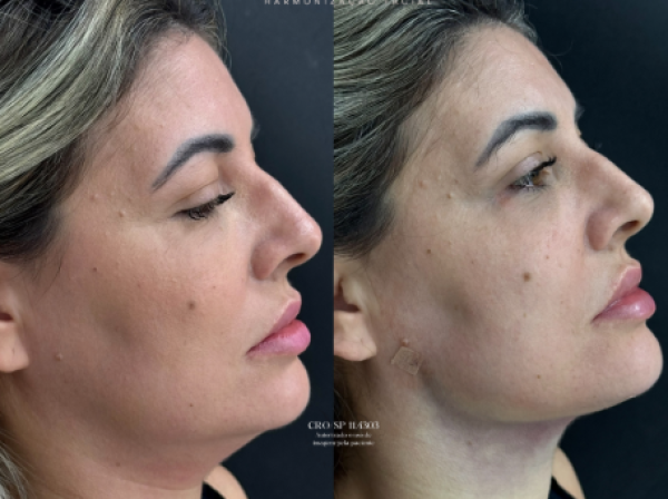 ANTES  | DEPOIS