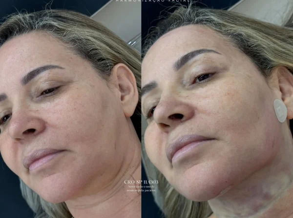 ANTES  | DEPOIS