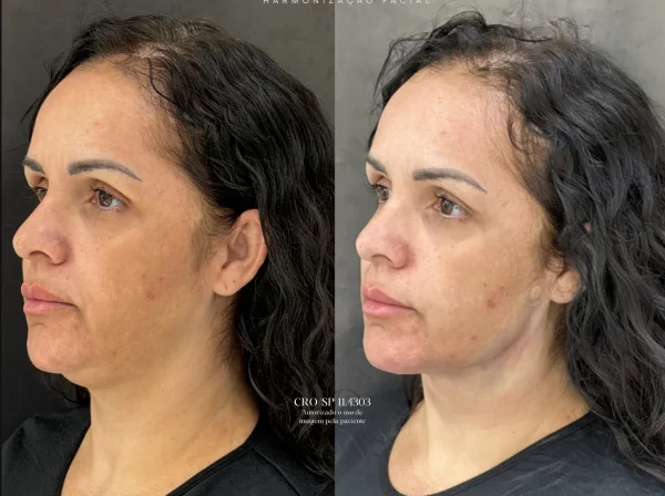 ANTES  | DEPOIS