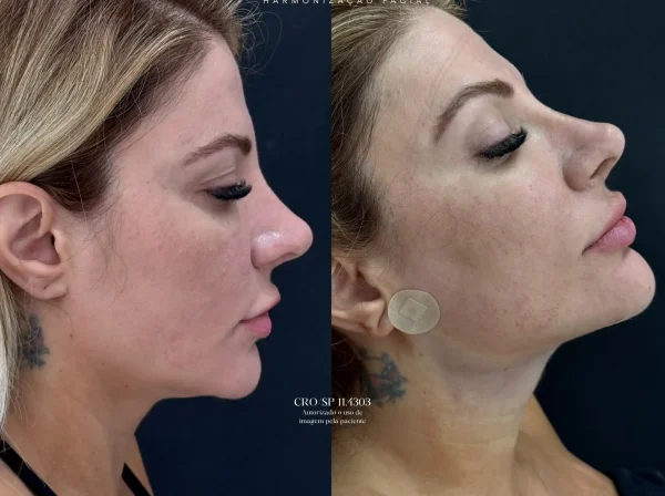 ANTES  | DEPOIS