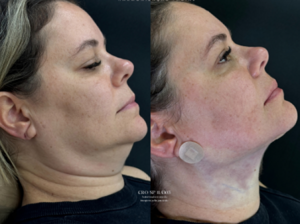 ANTES  | DEPOIS